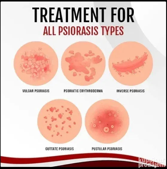 Sprej za lečenje psorijaze