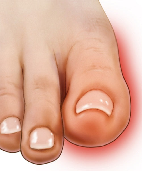 Anatomski Štitnik Za Čukljeve Hallux Valgus - Anatomski Štitnik Za Čukljeve Hallux Valgus